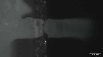 UM3 骨の中で起きている小さな骨折